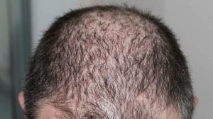 Caduta dei capelli, dai rimedi alle informazioni utili